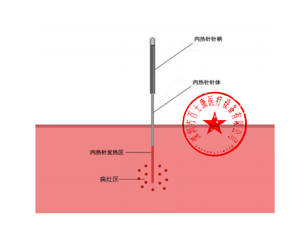 内热针治疗仪 （ NRZ-40R-C)